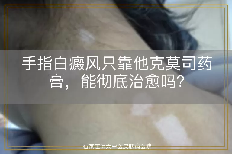 手指白癜风只靠他克莫司药膏，能彻底治愈吗？