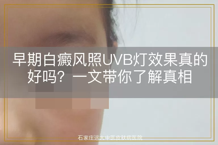 早期白癜风照UVB灯效果真的好吗？一文带你了解真相
