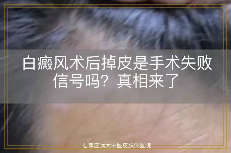 白癜风术后掉皮是手术失败信号吗？真相来了