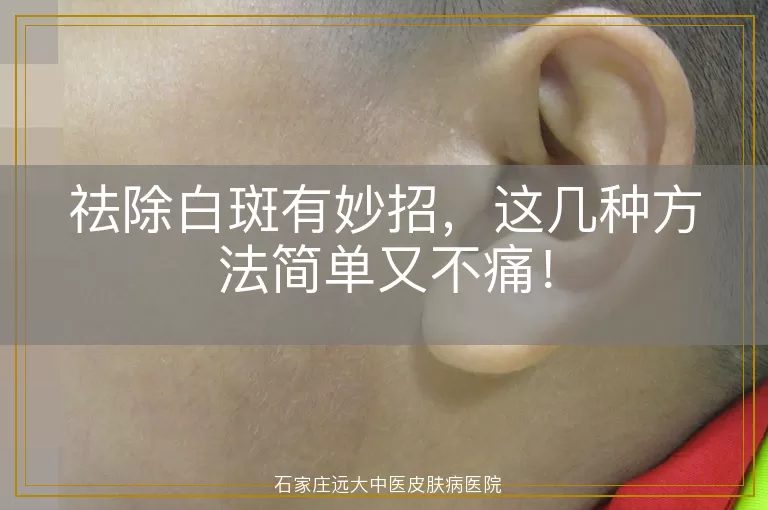 祛除白斑有妙招，这几种方法简单又不痛！