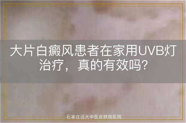 大片白癜风患者在家用UVB灯治疗，真的有效吗？