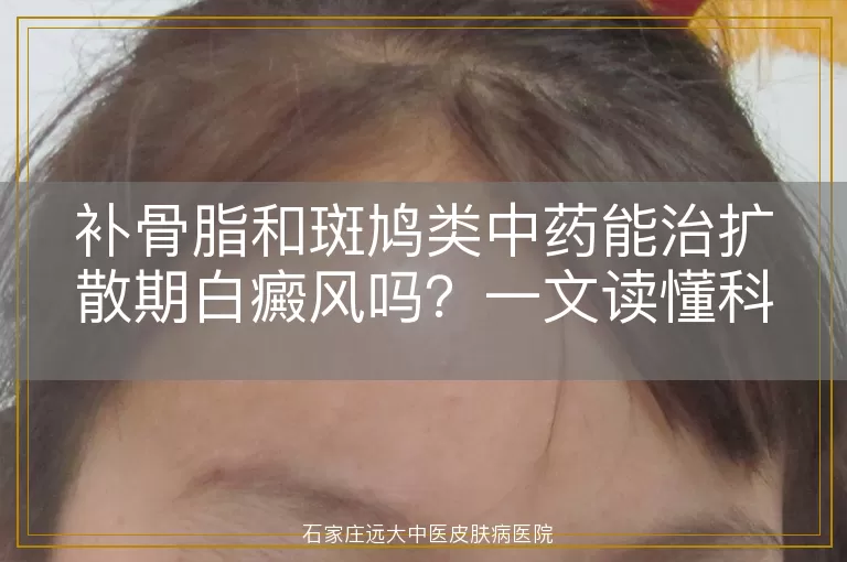 补骨脂和斑鸠类中药能治扩散期白癜风吗？一文读懂科学用药关键
