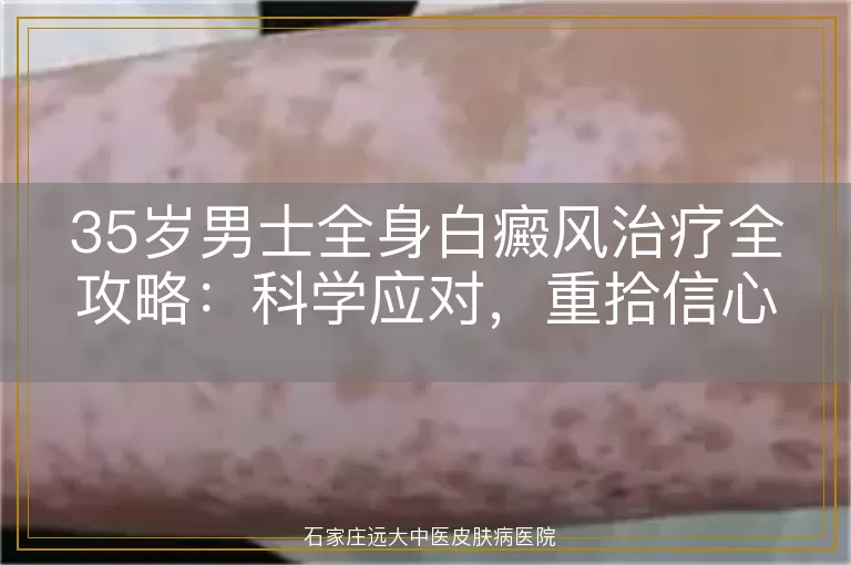 35岁男士全身白癜风治疗全攻略：科学应对，重拾信心