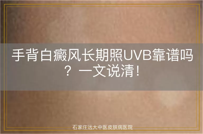手背白癜风长期照UVB靠谱吗？一文说清！