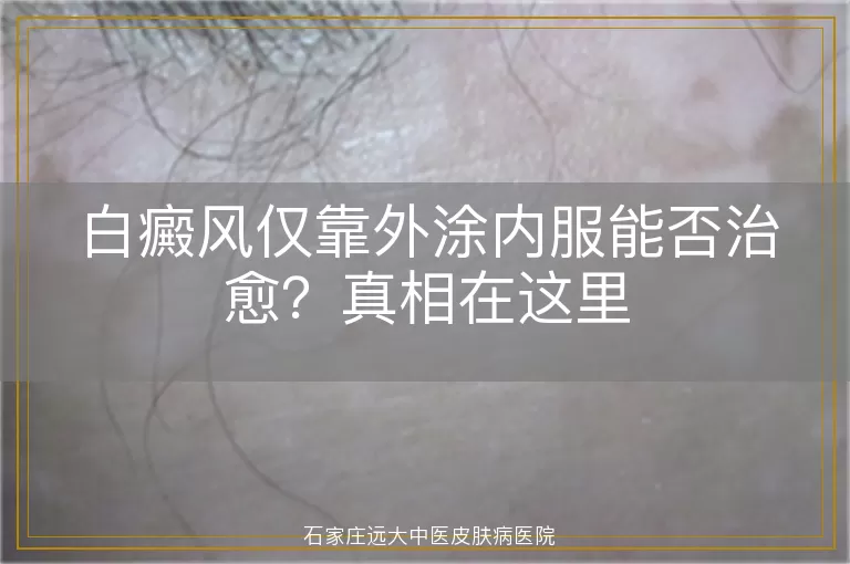 白癜风仅靠外涂内服能否治愈？真相在这里