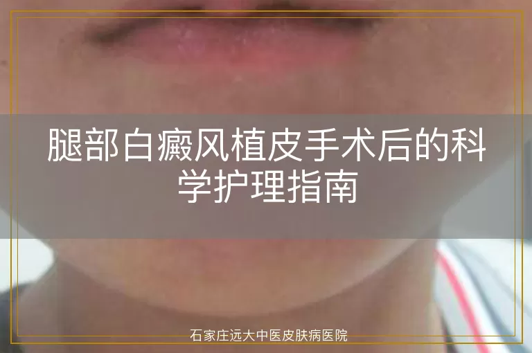腿部白癜风植皮手术后的科学护理指南