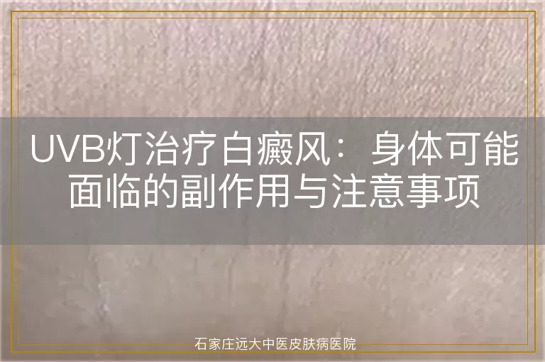 UVB灯治疗白癜风：身体可能面临的副作用与注意事项