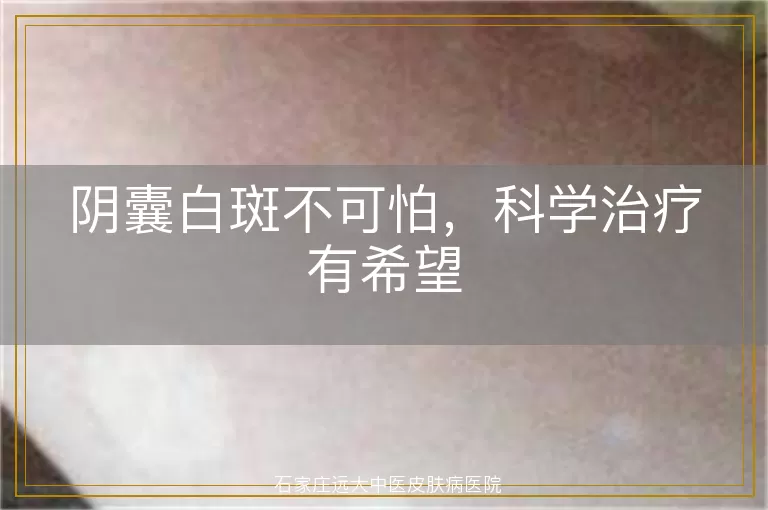 阴囊白斑不可怕，科学治疗有希望