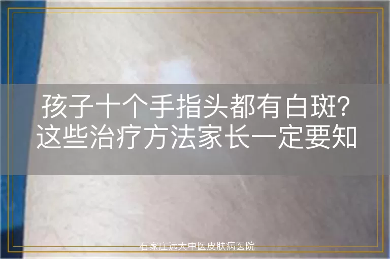 孩子十个手指头都有白斑？这些治疗方法家长一定要知道