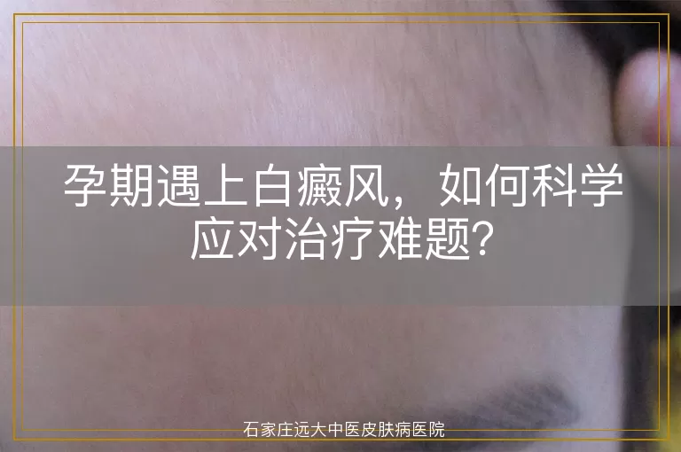 孕期遇上白癜风，如何科学应对治疗难题？
