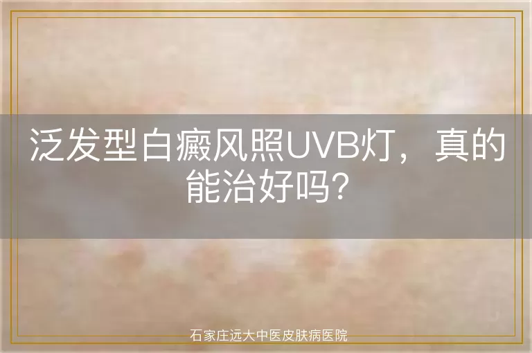泛发型白癜风照UVB灯，真的能治好吗？