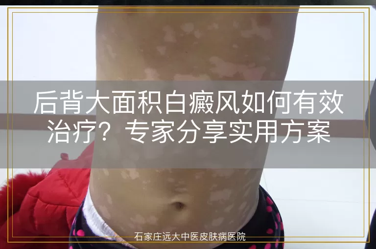 后背大面积白癜风如何有效治疗？专家分享实用方案