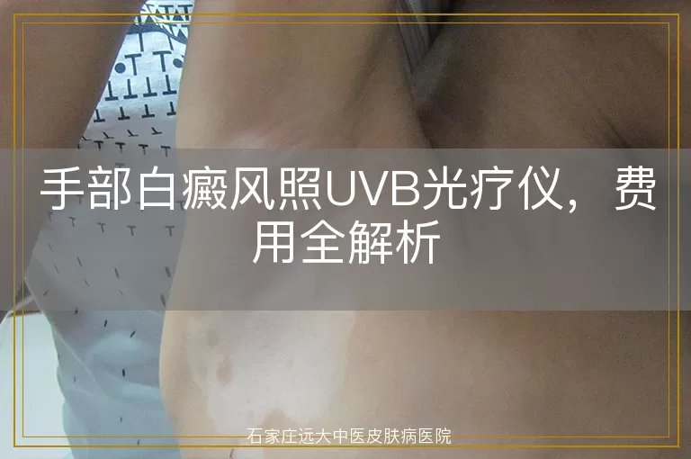 手部白癜风照UVB光疗仪，费用全解析