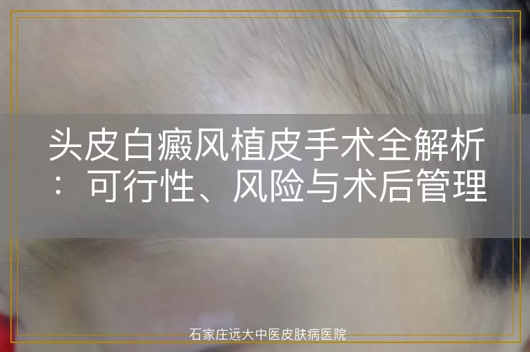 头皮白癜风植皮手术全解析：可行性、风险与术后管理
