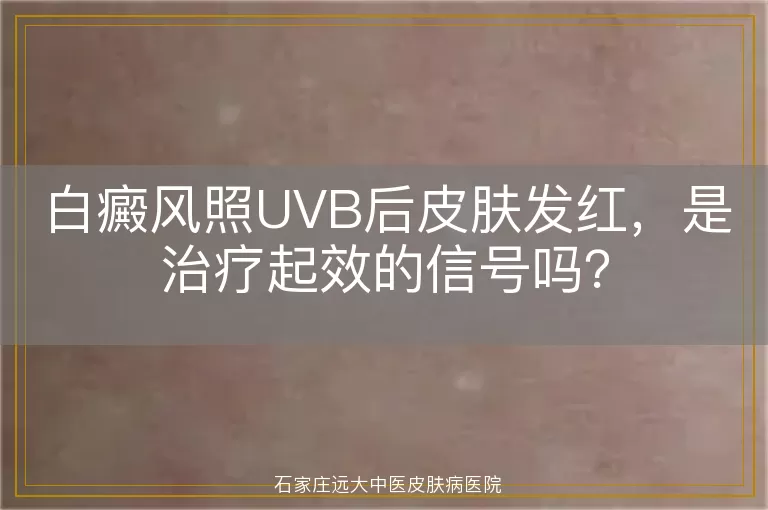 白癜风照UVB后皮肤发红，是治疗起效的信号吗？