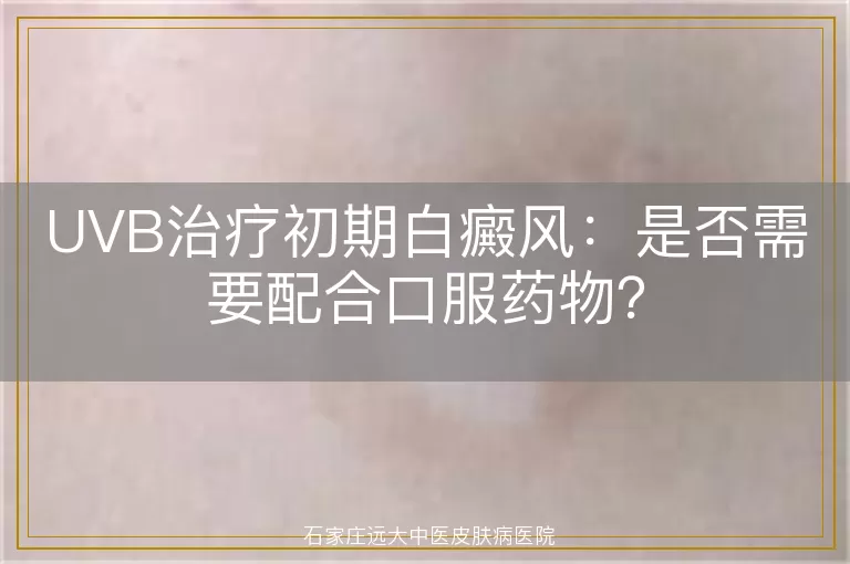 UVB治疗初期白癜风：是否需要配合口服药物？