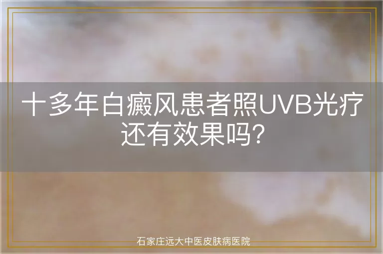 十多年白癜风患者照UVB光疗还有效果吗？