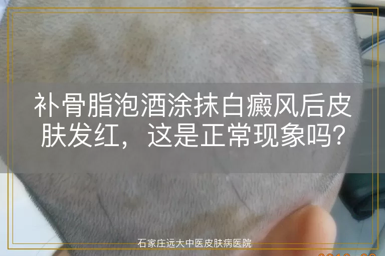 补骨脂泡酒涂抹白癜风后皮肤发红，这是正常现象吗？