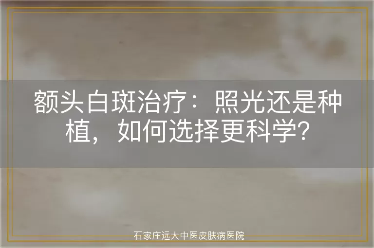 额头白斑治疗：照光还是种植，如何选择更科学？