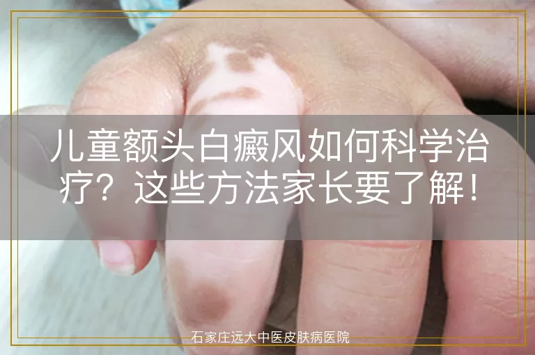 儿童额头白癜风如何科学治疗？这些方法家长要了解！