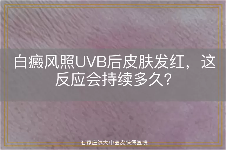 白癜风照UVB后皮肤发红，这反应会持续多久？