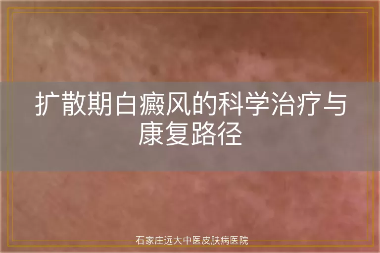 扩散期白癜风的科学治疗与康复路径