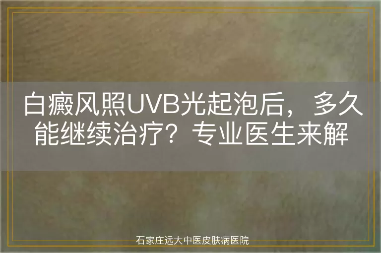 白癜风照UVB光起泡后，多久能继续治疗？专业医生来解答
