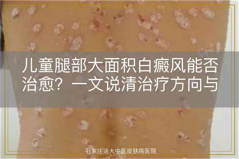 儿童腿部大面积白癜风能否治愈？一文说清治疗方向与家庭护理
