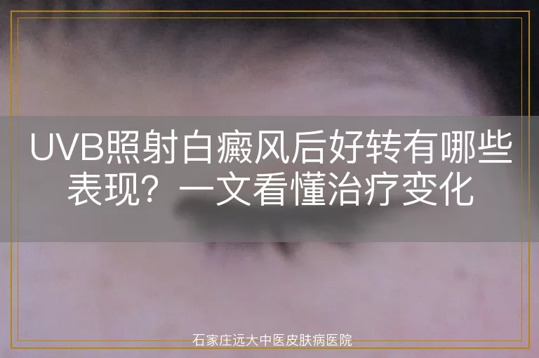 UVB照射白癜风后好转有哪些表现？一文看懂治疗变化