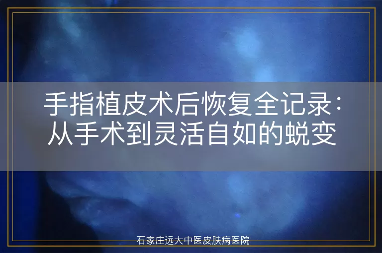 手指植皮术后恢复全记录：从手术到灵活自如的蜕变