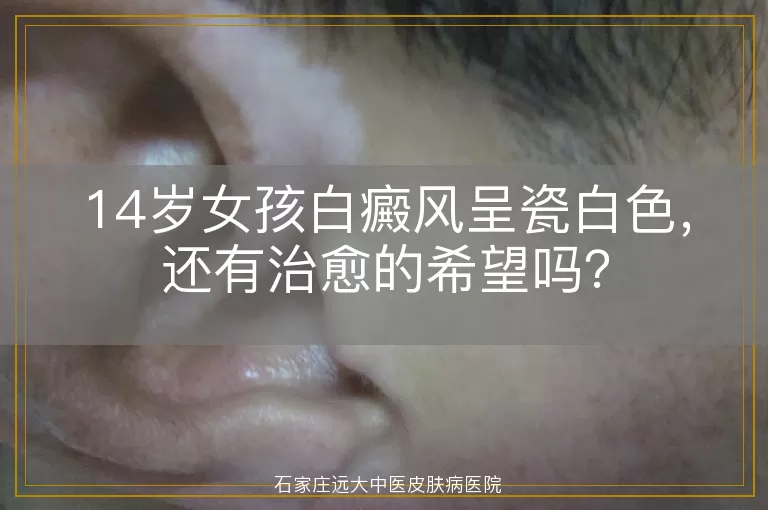 14岁女孩白癜风呈瓷白色，还有治愈的希望吗？