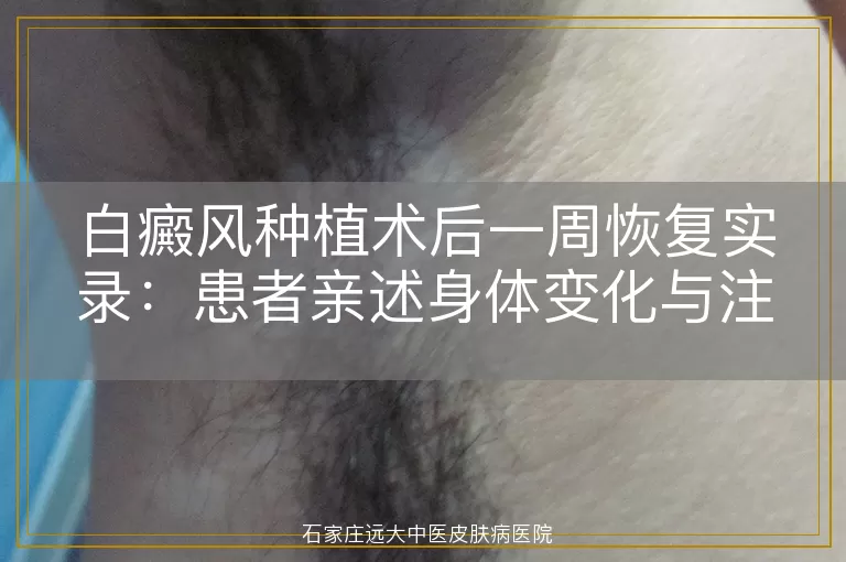 白癜风种植术后一周恢复实录：患者亲述身体变化与注意事项