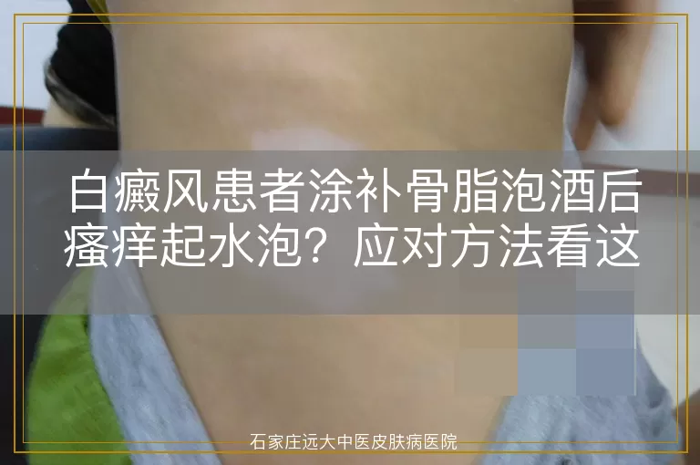 白癜风患者涂补骨脂泡酒后瘙痒起水泡？应对方法看这里