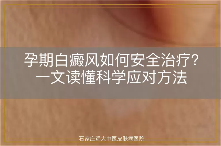 孕期白癜风如何安全治疗？一文读懂科学应对方法