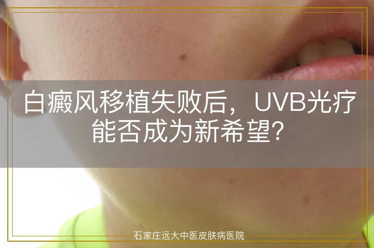 白癜风移植失败后，UVB光疗能否成为新希望？