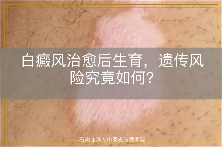 白癜风治愈后生育，遗传风险究竟如何？