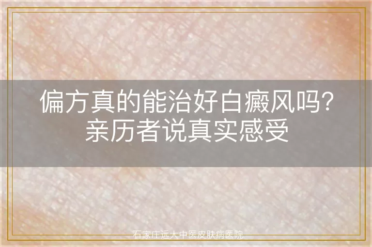 偏方真的能治好白癜风吗？亲历者说真实感受