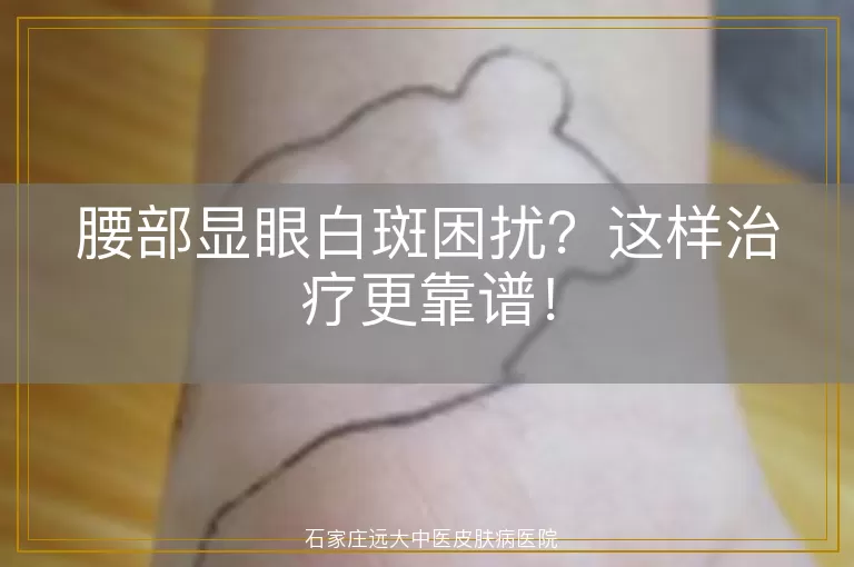 腰部显眼白斑困扰？这样治疗更靠谱！