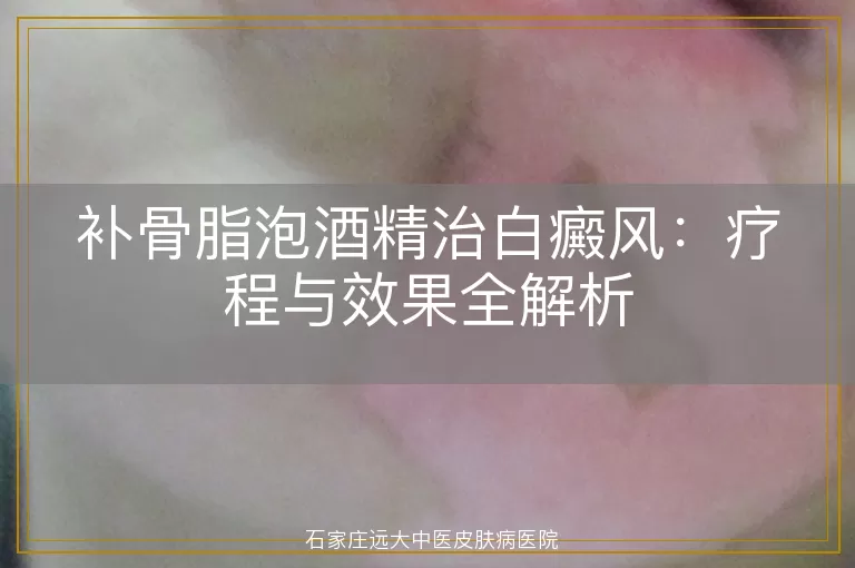 补骨脂泡酒精治白癜风：疗程与效果全解析