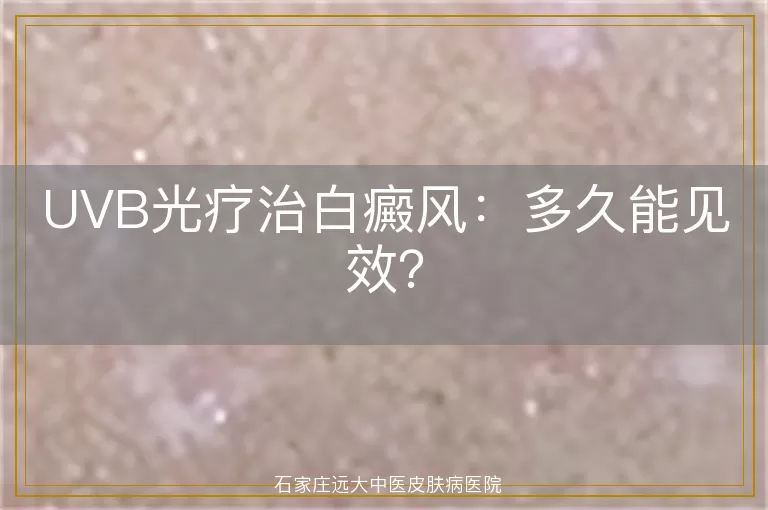 UVB光疗治白癜风：多久能见效？