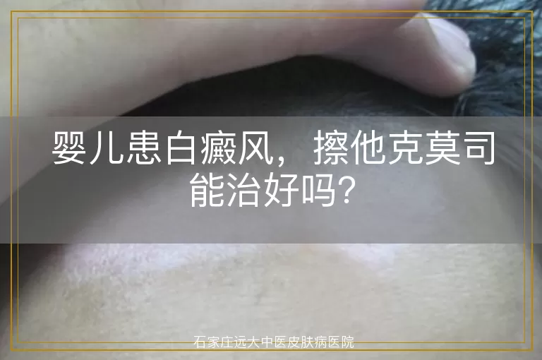 婴儿患白癜风，擦他克莫司能治好吗？
