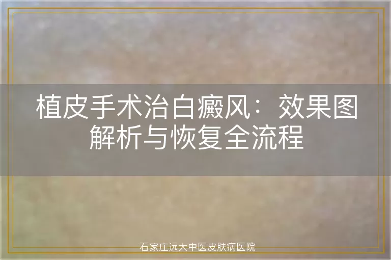 植皮手术治白癜风：效果图解析与恢复全流程