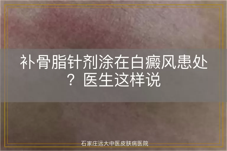 补骨脂针剂涂在白癜风患处？医生这样说