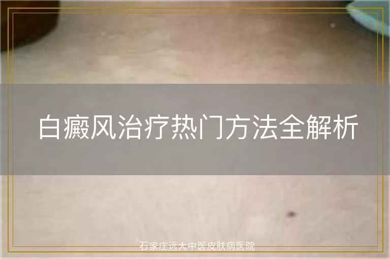 白癜风治疗热门方法全解析