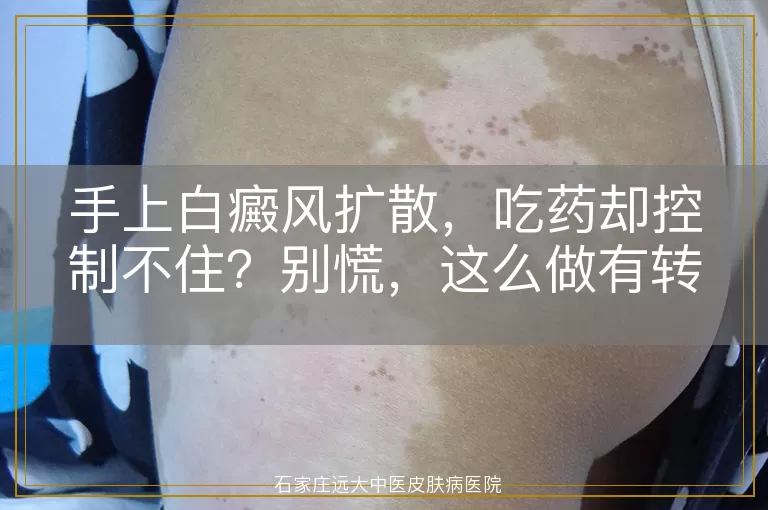手上白癜风扩散，吃药却控制不住？别慌，这么做有转机