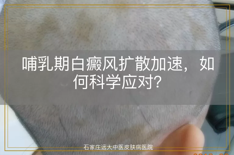 哺乳期白癜风扩散加速，如何科学应对？