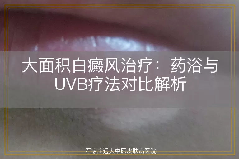大面积白癜风治疗：药浴与UVB疗法对比解析