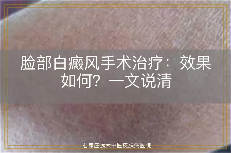 脸部白癜风手术治疗：效果如何？一文说清