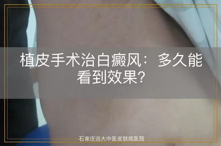 植皮手术治白癜风：多久能看到效果？