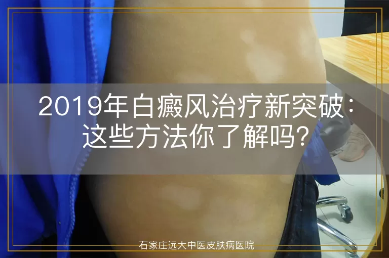 2019年白癜风治疗新突破：这些方法你了解吗？